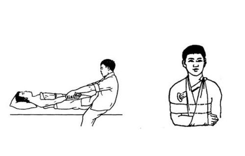 肩关节反复脱位影响干体力活吗,肩关节反复脱位核磁表现