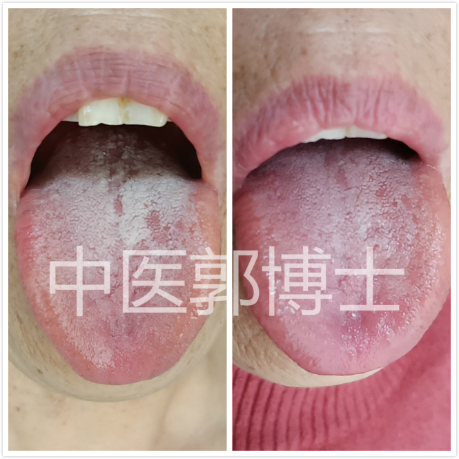 舌苔厚腻微黄用什么中药,下焦舌苔厚腻白用什么中药