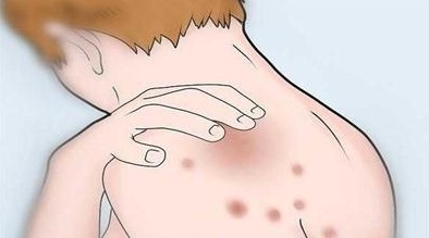 如何正确找到长痘的原因,为什么会长痘又怎样防治