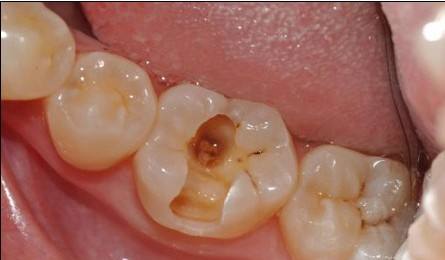 补牙是把牙洞都填平了吗,为啥补牙要把小洞变大