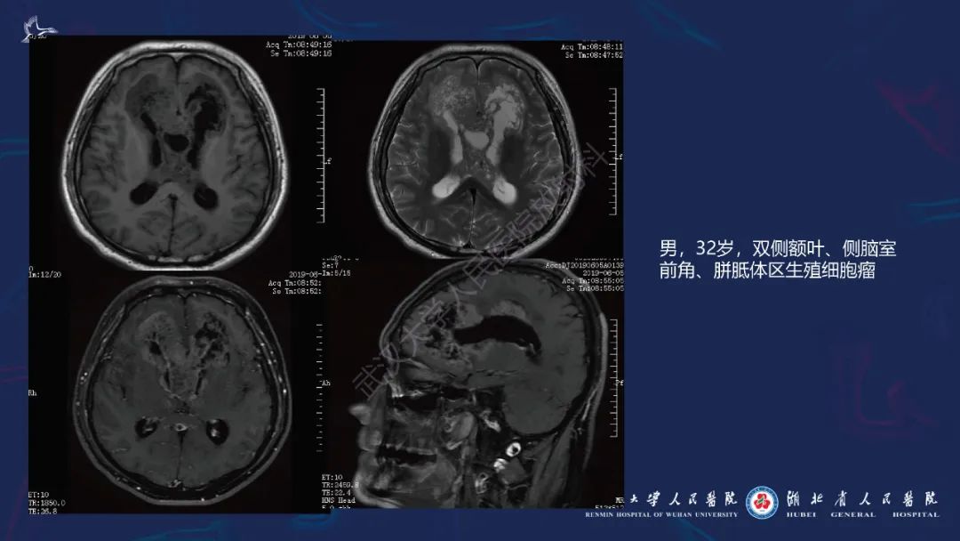 胼胝体肿瘤影像鉴别,胼胝体病变影像诊断