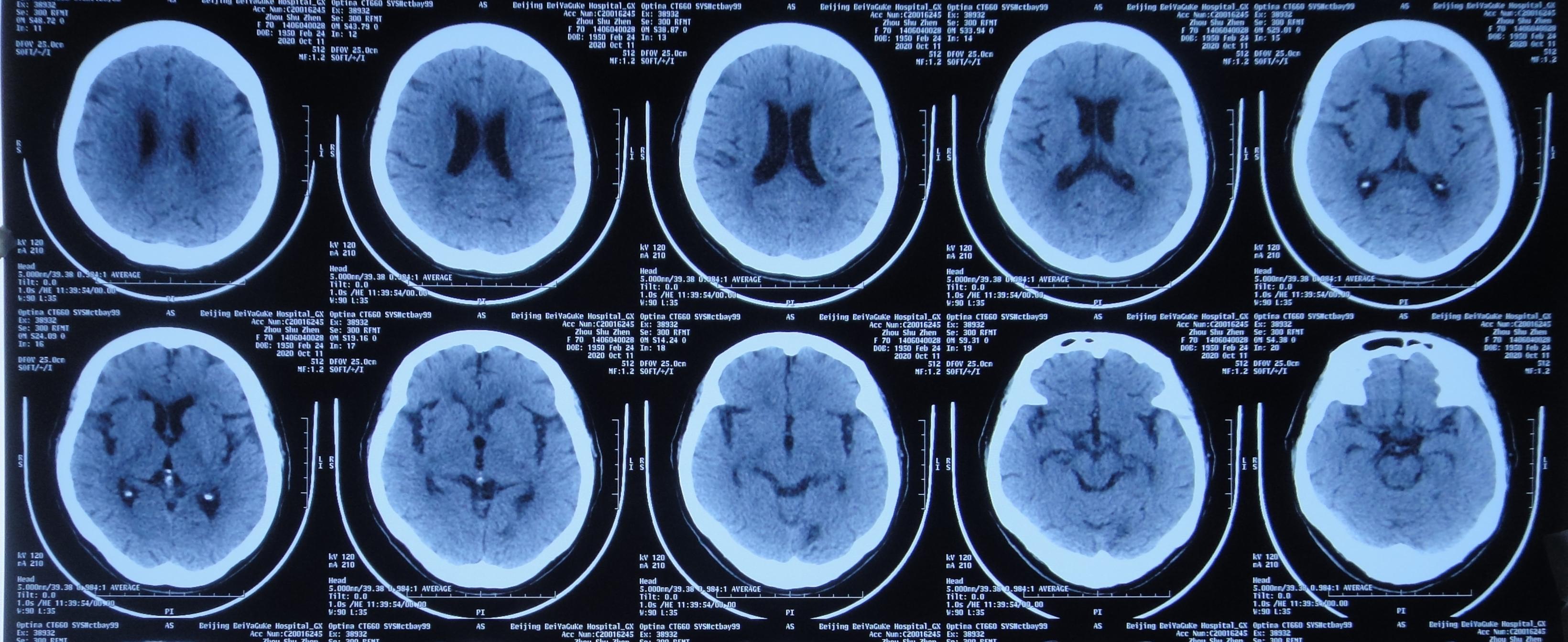 颈椎术后脑脊液漏取什么体位,脊髓型颈椎病手术后植骨愈合时间