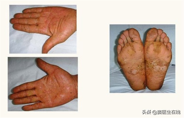 “脚气”真菌怎么治才能根除？2个简单小方法，彻底治好不复发