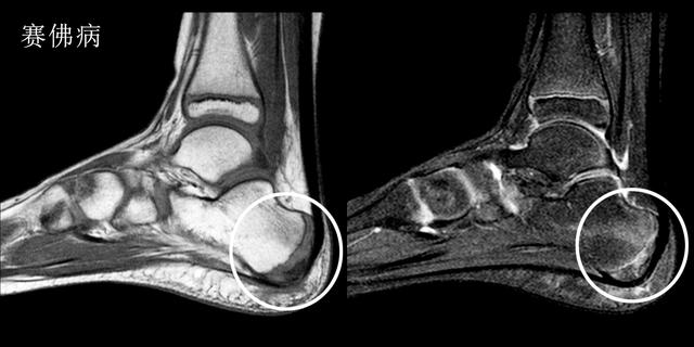 跑步足跟痛的原因及治疗方法,产后足跟痛是什么原因引起的