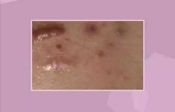 痘痘为什么越来越多如何正确祛痘,祛痘痘的效果是长痘痘还是消痘痘