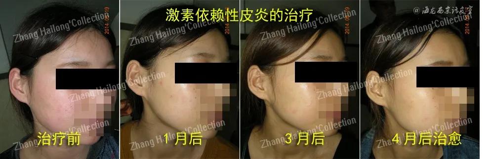 护肤一定要坚持且要有耐心,激素依赖性皮炎怎么护肤