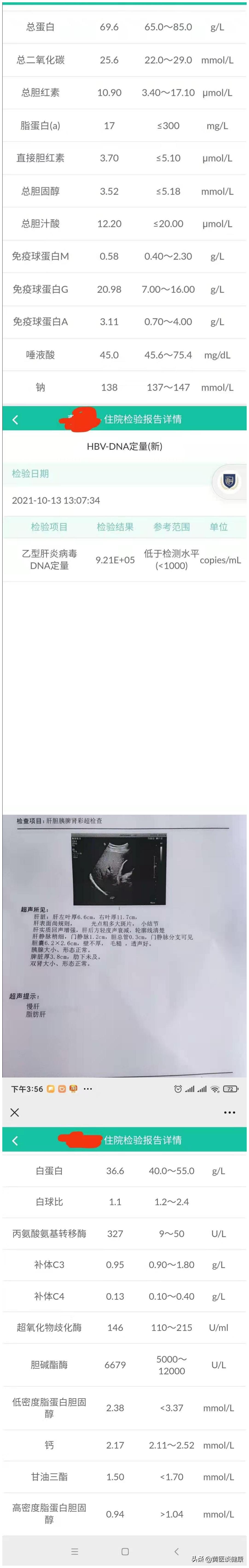 替诺福韦耐药肝功能正常,替诺福韦抗病毒后胆红素高怎么办