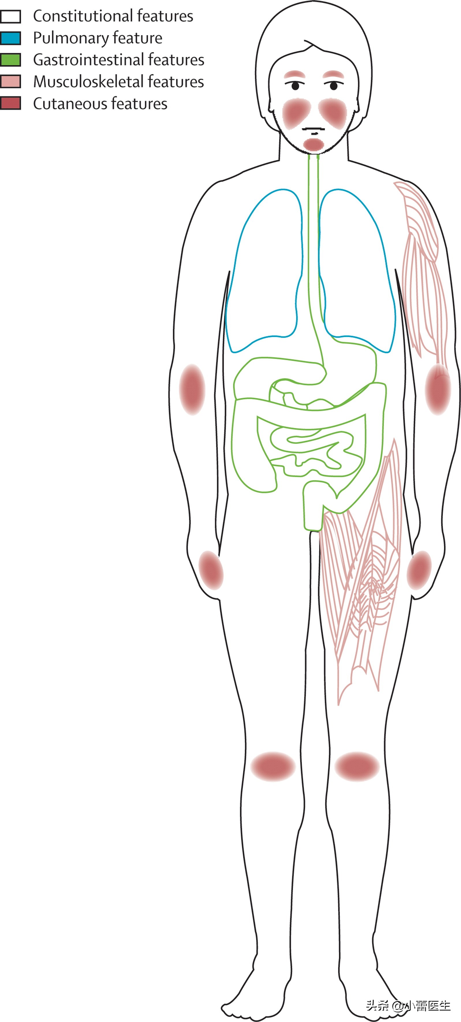 肩肌炎严重吗,从肩到后背疼痛是什么原因