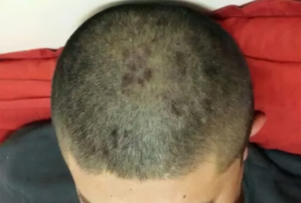 头皮上总出油长有疙瘩或脓包,头皮老是长疙瘩是咋回事