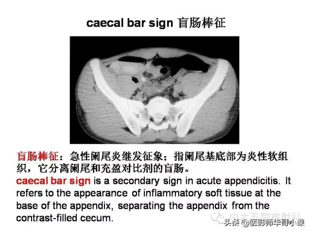 阑尾炎课件,阑尾炎的超声课件