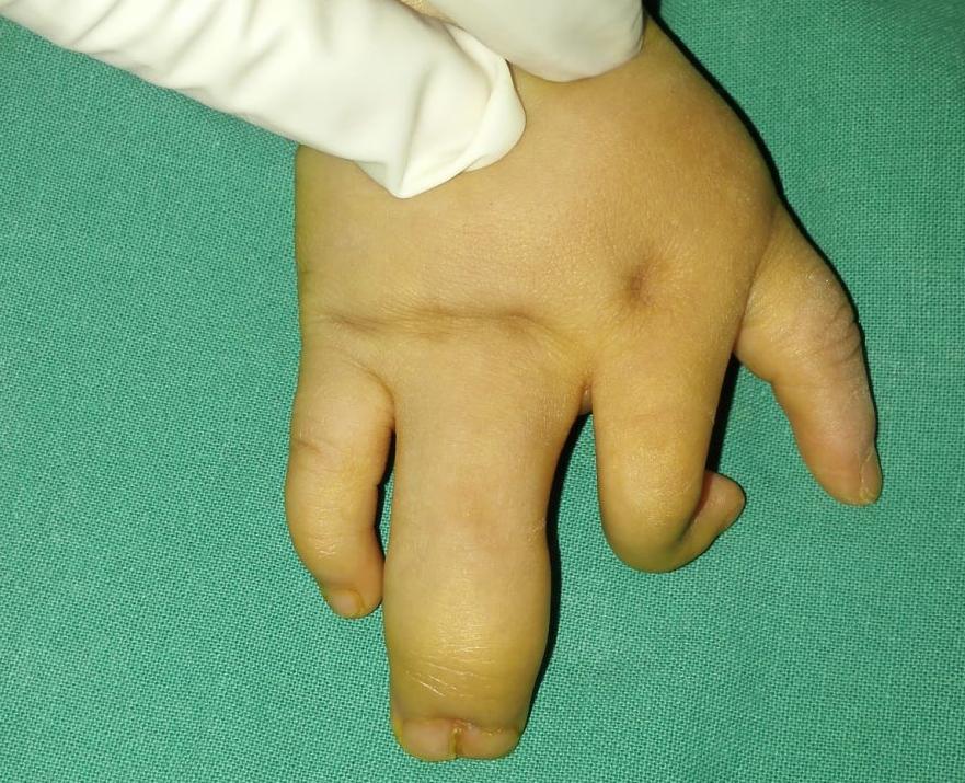 并指畸形免植皮案例,并指畸形