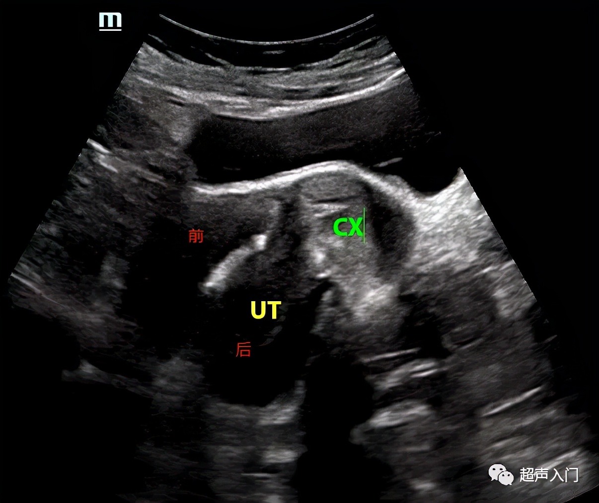 超声怎么分辨前后位子宫,超声如何区分子宫前后位