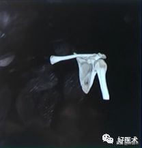 肩锁关节脱位手术后多久可以喝酒,肩锁关节脱位钢板内固定步骤记录