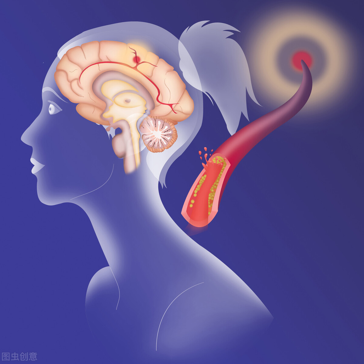 预防脑梗的最好中成药,脑梗最怕的两种维生素是哪两种