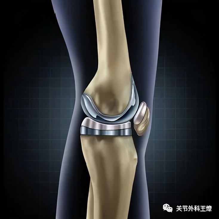 人工膝关节什么时间降价,人工膝关节使用60年寿命