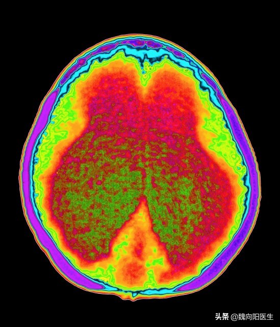 痴呆症怎么彻底治愈,痴呆症可以治愈吗