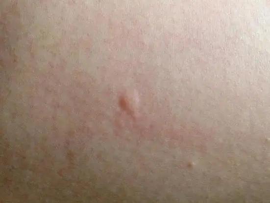 丁丁被蜜蜂叮了会怎么样,钓鱼被蚊虫咬出包怎么办