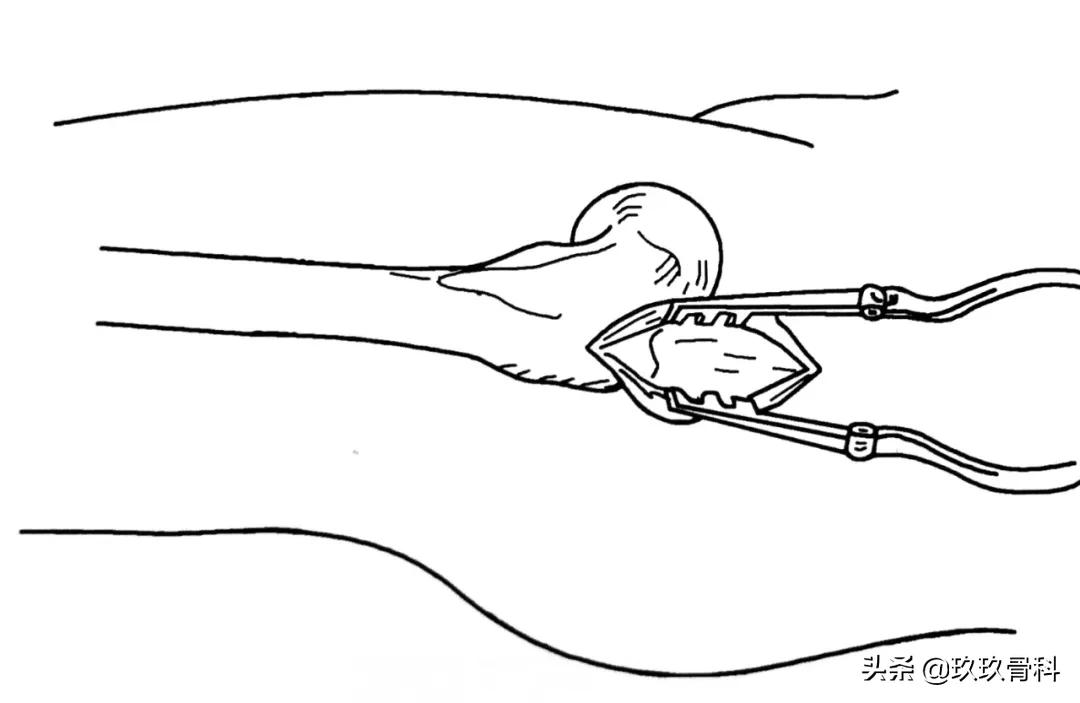 骨科取髓内钉的视频,骨科髓内钉内固定术式简写