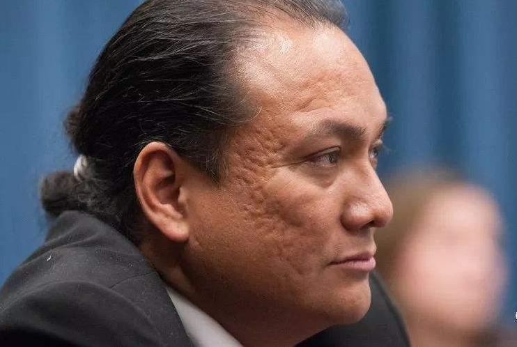 如何区分各种痘印的原因,痘印有哪些种类型