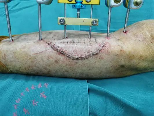 糖尿病足手术后又坏死怎办,糖尿病足部溃烂截肢手术
