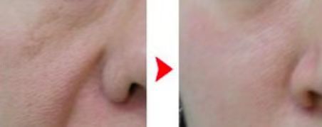 如何把法令纹变成一件高级的事