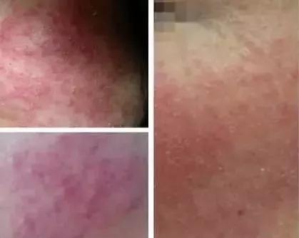 激素脸皮肤红烫是怎么回事,皮肤问题一直查不出原因