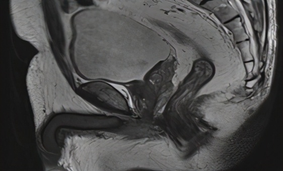 低位直肠癌保肛手术不造瘘利弊,低位直肠癌保肛会影响复发率么