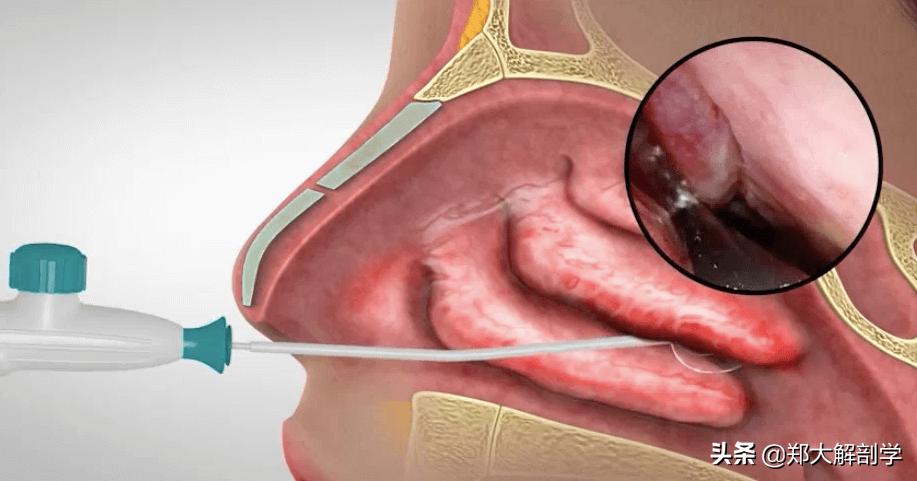 过敏性鼻炎咳嗽,过敏性鼻炎吃什么药