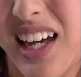 骨性龅牙和牙性龅牙的区别,牙性龅牙和骨性龅牙怎么矫正