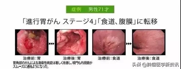 癌症患者的生存几率多大,国内癌症医疗和国外癌症医疗现状