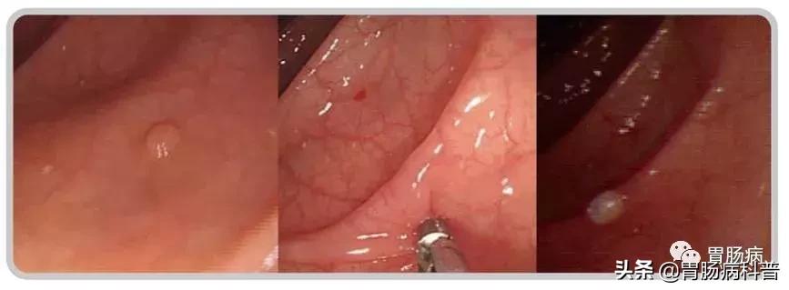 切肠息肉有风险吗,肠息肉为什么大了不能直接切