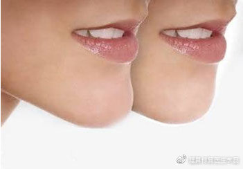 下巴骨雕整形是怎么回事,下巴整形一般要恢复多久