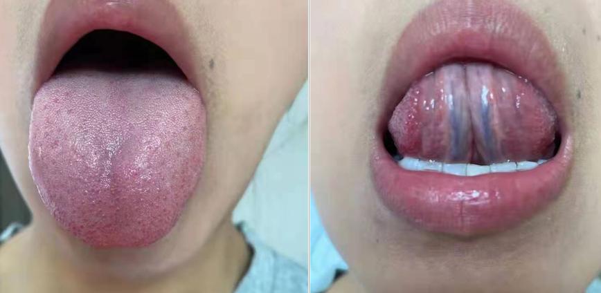 脱肛补中益气汤配方,吃补中益气丸一年能治好宝宝脱肛吗