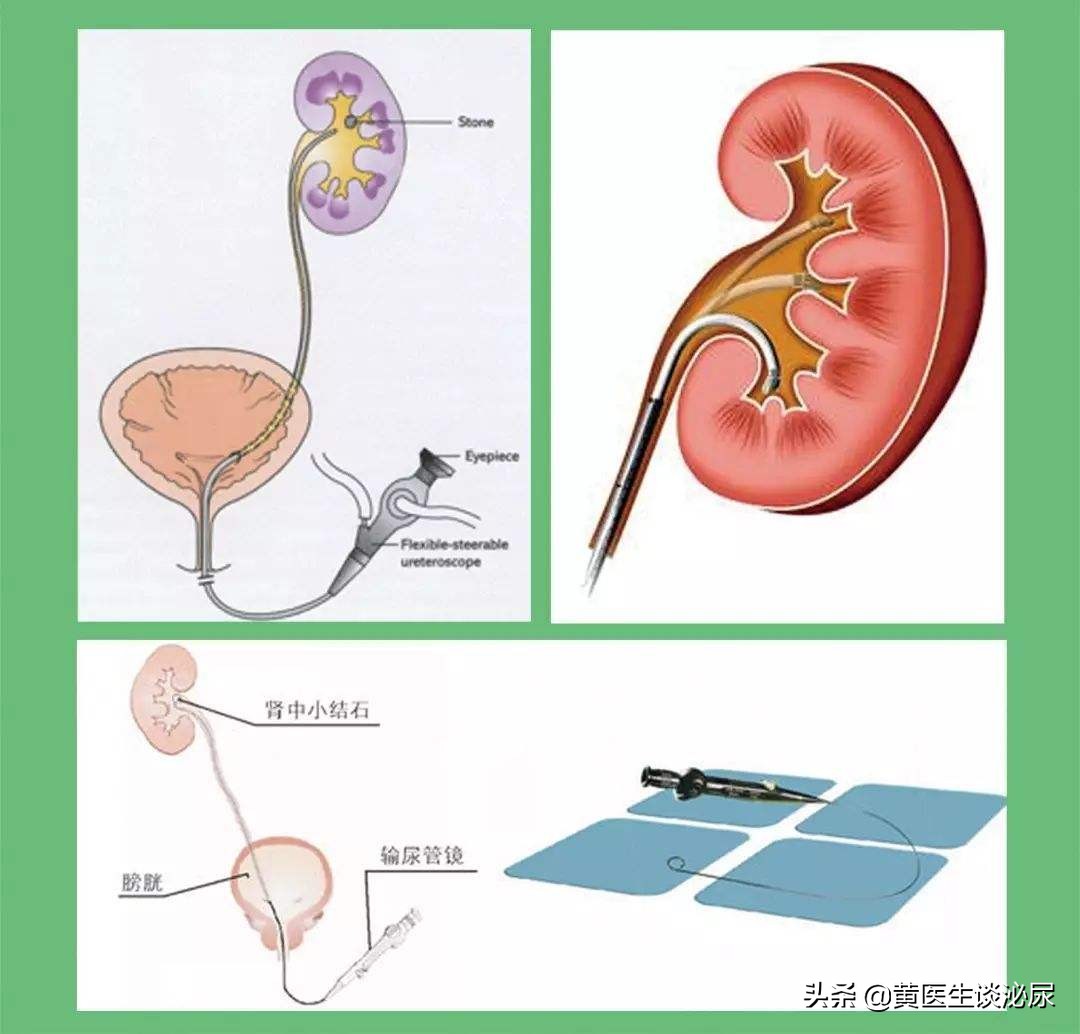 如果得了肾结石是不是必须碎石,如果得了肾结石如何治疗好