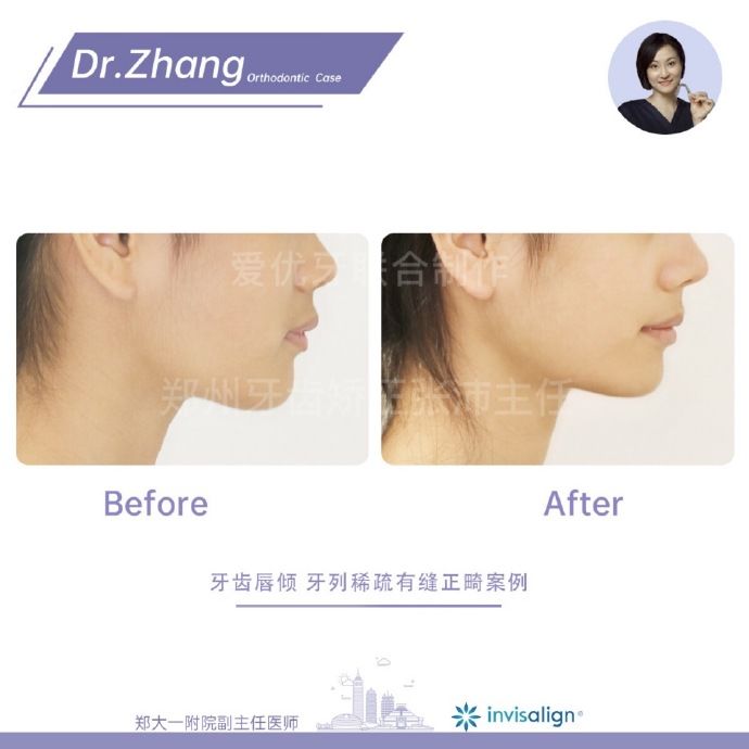 郑州矫正牙齿整形哪个医院好,郑州牙齿局部矫正