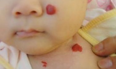 宝宝胎记的症状有哪些,宝宝出生有胎记是怎么来的