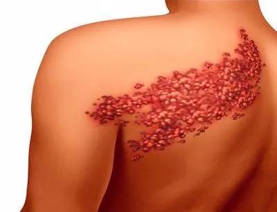 疱疹容易反复发作，这些类型不可不知