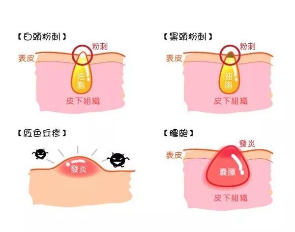 挤闭口粉刺有效吗,挤下巴闭口粉刺