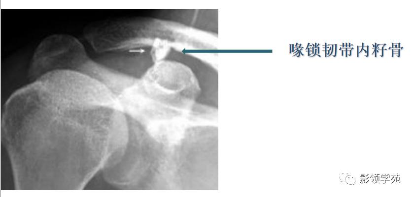 桡骨远端骨折引起尺骨变异,撕脱骨折一个月无明显骨痂形成