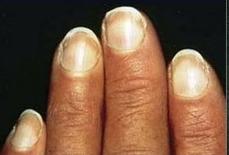 指甲问题对应身体哪里有问题,指甲的各种病变及解决办法