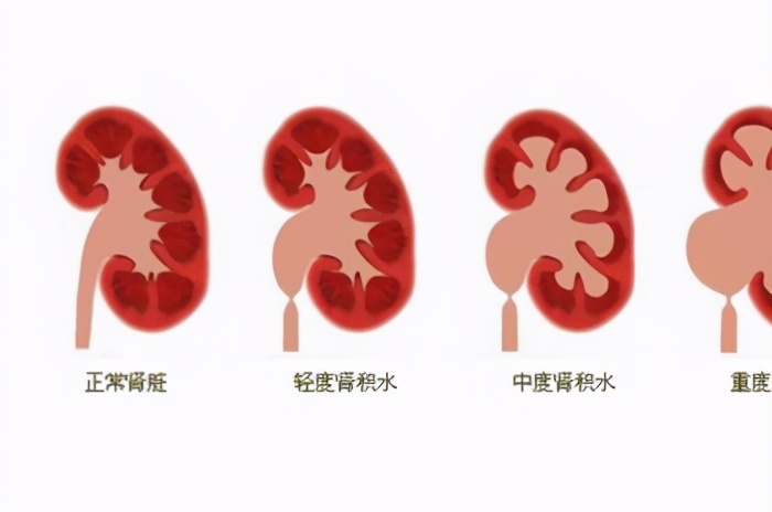 严重肾积水可以保守治疗吗,严重肾积水需要治疗吗