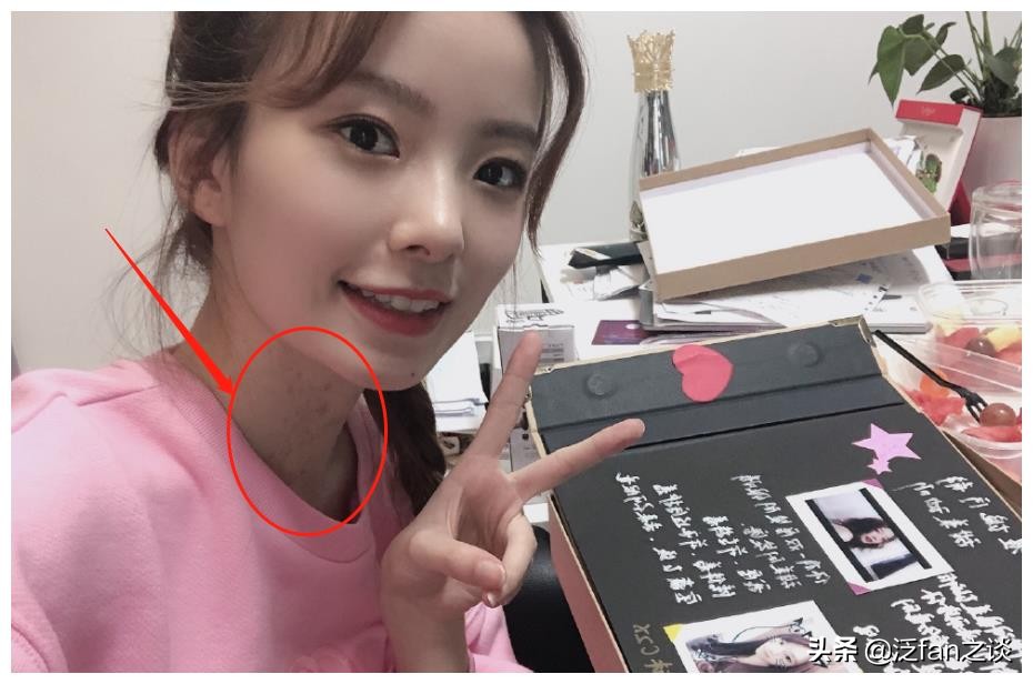 陈卓璇脖子的胎记用什么遮住了,陈卓璇谈胎记