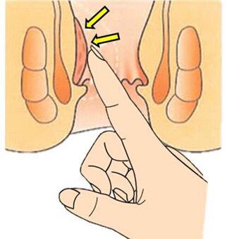 内痔是啥,什么叫内痔