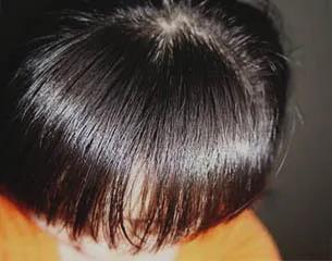 发根白怎么治疗,发根下面有一排白斑