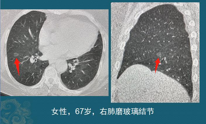 肺结节1.7x1.4磨玻璃结节严重吗,磨玻璃肺结节要动手术吗