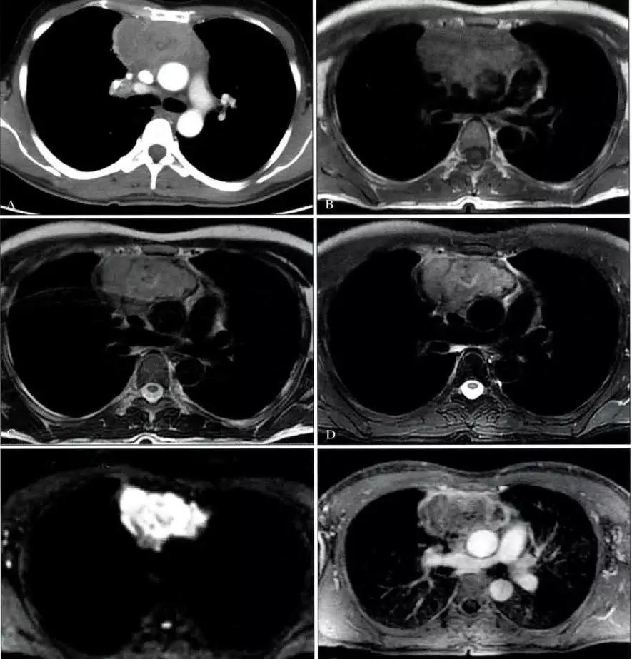 前上纵隔高密度影考虑胸腺未退化,肺纵隔胸腺结节12mm看什么科