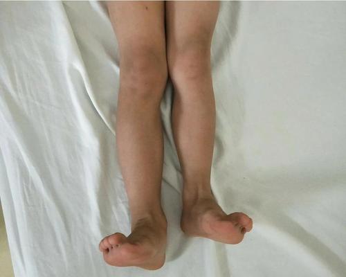 双腿大小不一样,小孩双腿大小不一样