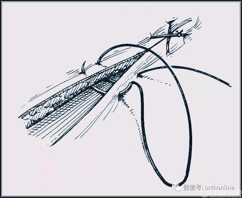 十种外科基本缝合方式详解,手术切口缝合有哪几种