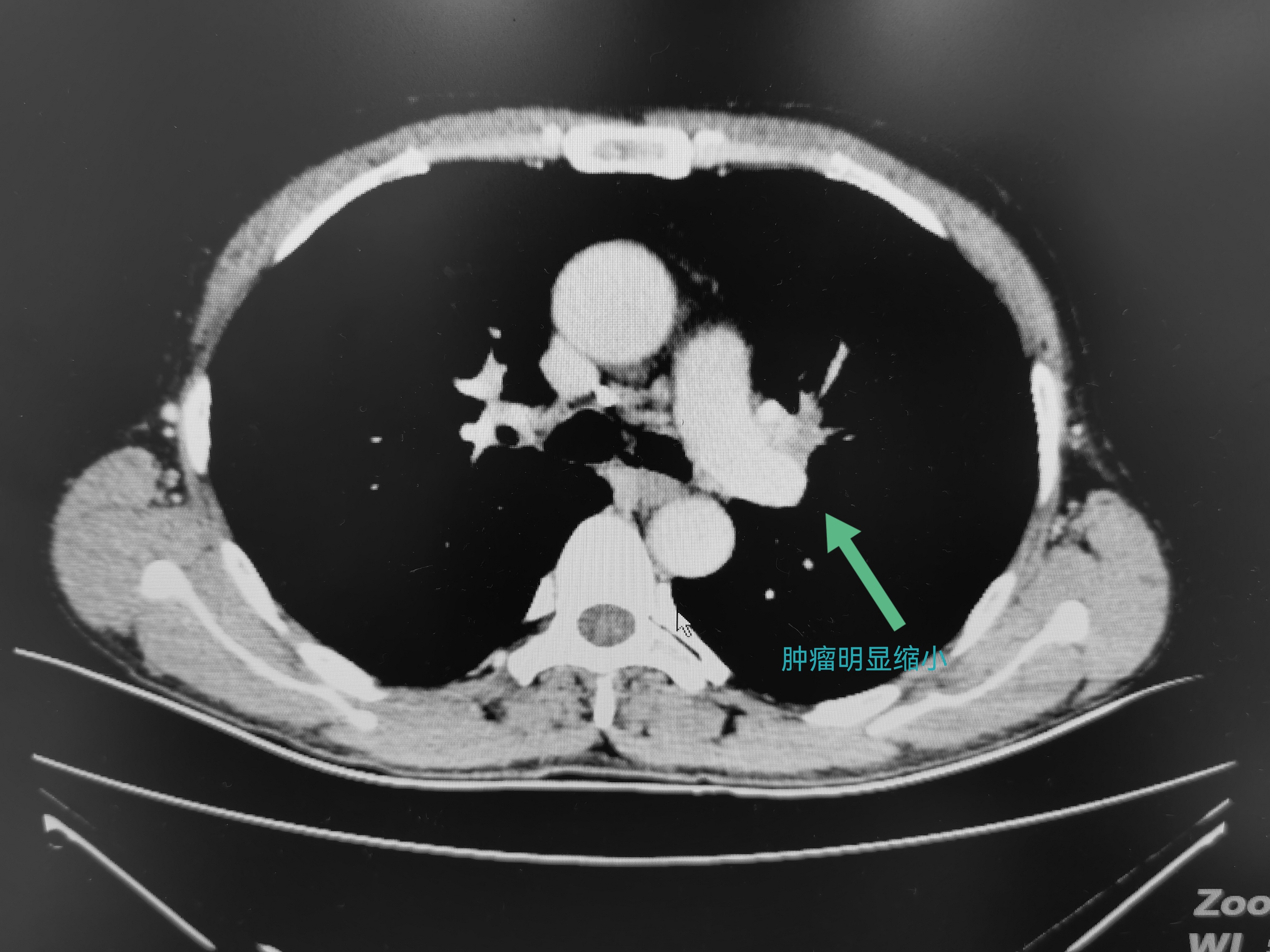 肺癌综合诊疗,肺癌诊疗一体化模式