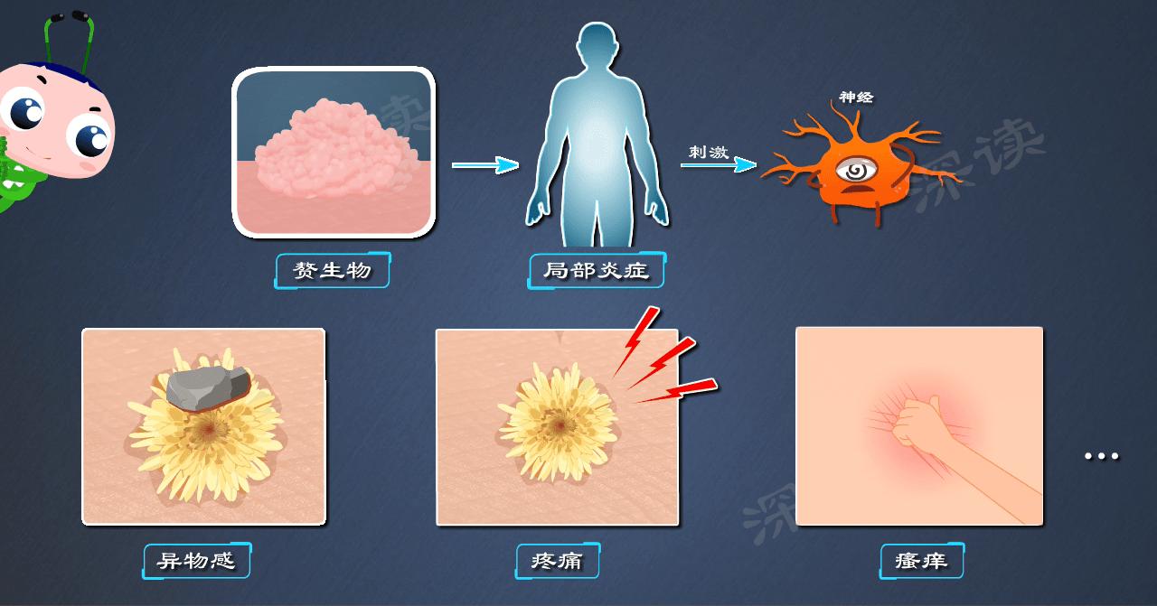 明明没出轨，为啥染上尖锐湿疣？*处私**咋就长出“菜花”了？